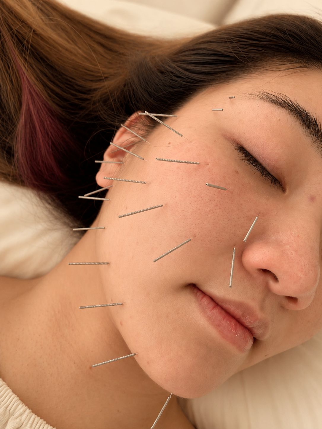 Facial Acupuncture